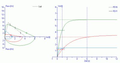 Fluß- Volumenkurve Lungenfunktionsmessung